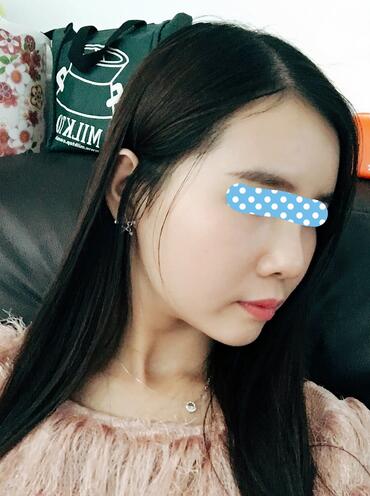 自体脂肪填充后2个月图