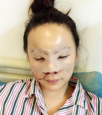 隆隆鼻整形隆鼻1个月