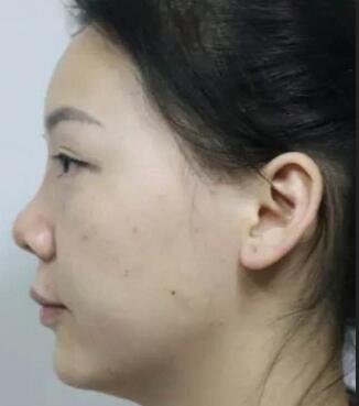 隆隆鼻整形隆鼻1个月