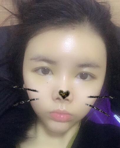 p自体脂肪填充半个月