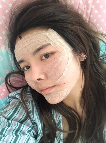 p自体脂肪填充半个月