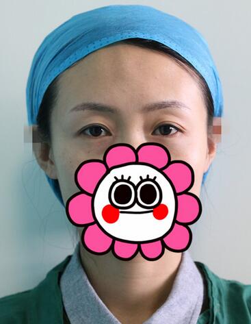 北京丽星双眼皮修复半年了
