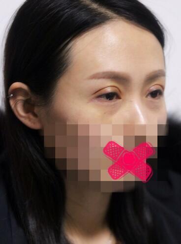 北京丽星双眼皮修复半年了