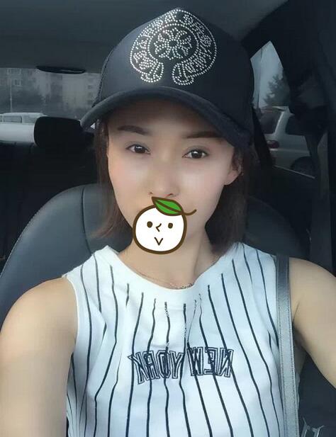北京丽星双眼皮修复半年了
