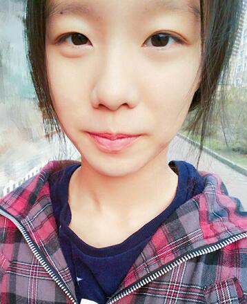 微创定点每天恢复过程图 北京丽星双眼皮3个月