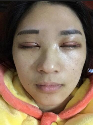 微创定点每天恢复过程图 北京丽星双眼皮3个月