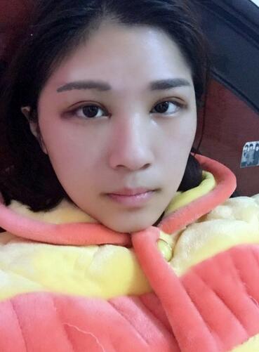 微创定点每天恢复过程图 北京丽星双眼皮3个月