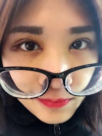 微创定点每天恢复过程图 北京丽星双眼皮3个月