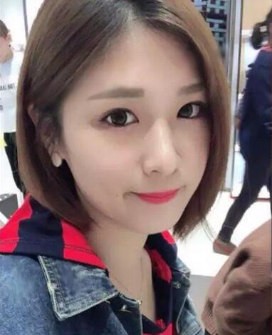 微创定点每天恢复过程图 北京丽星双眼皮3个月