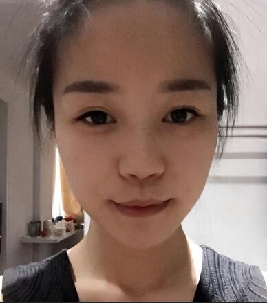 硅胶隆鼻前后对比 硅胶隆鼻+鼻小柱延长恢复日记