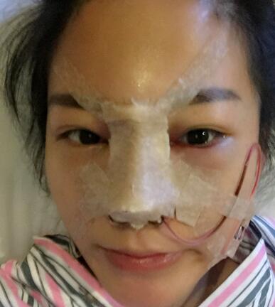 硅胶隆鼻前后对比 硅胶隆鼻+鼻小柱延长恢复日记