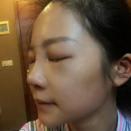 硅胶隆鼻前后对比 硅胶隆鼻+鼻小柱延长恢复日记