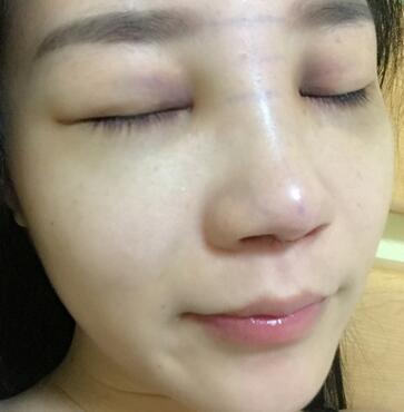 硅胶隆鼻前后对比 硅胶隆鼻+鼻小柱延长恢复日记