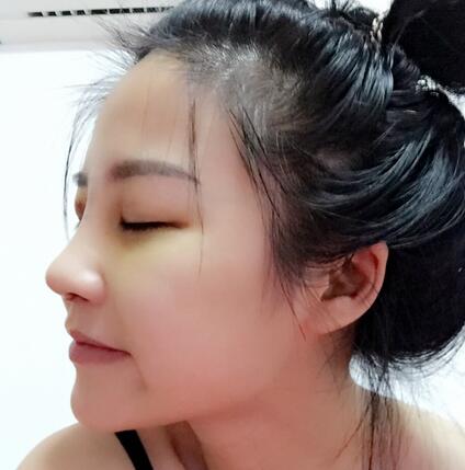 硅胶隆鼻前后对比 硅胶隆鼻+鼻小柱延长恢复日记