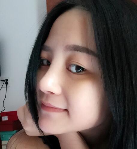 硅胶隆鼻前后对比 硅胶隆鼻+鼻小柱延长恢复日记