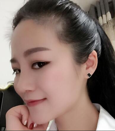 硅胶隆鼻前后对比 硅胶隆鼻+鼻小柱延长恢复日记