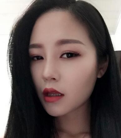 硅胶隆鼻前后对比 硅胶隆鼻+鼻小柱延长恢复日记