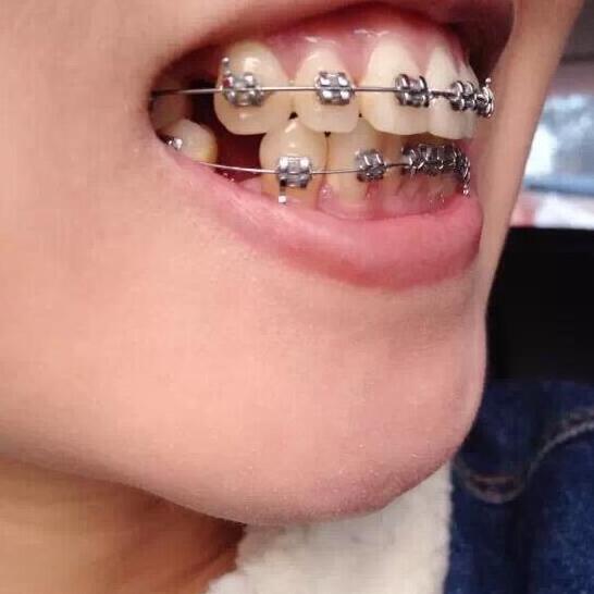 牙齿矫正前后对比照真实过程分享终于不是龅牙妹了哦