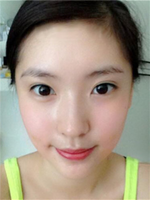 埋埋蛋白线.提升术后恢复记录分享还有对比照