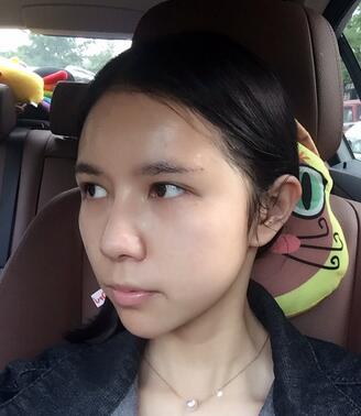 自体脂肪填充恢复日志 自体脂肪填充太阳穴+额头