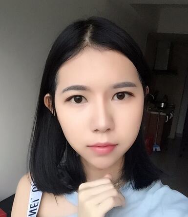 自体脂肪填充恢复日志 自体脂肪填充太阳穴+额头