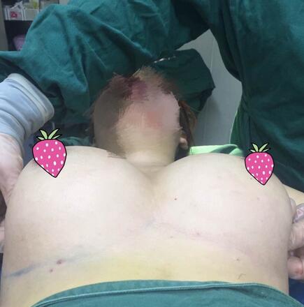 假体隆胸圆形果图 躺下果分享