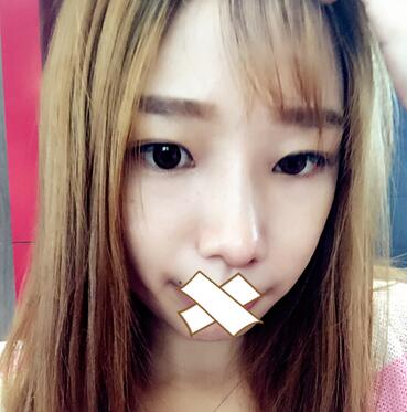 硅胶隆鼻恢复日记 硅胶隆鼻+鼻小柱延长+垫鼻尖