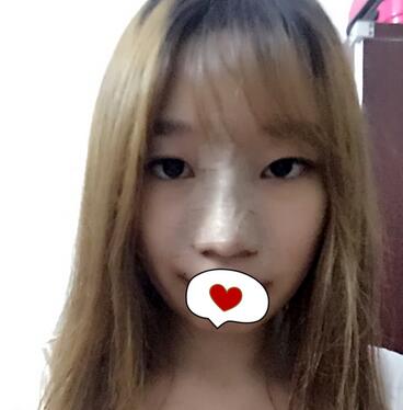 硅胶隆鼻恢复日记 硅胶隆鼻+鼻小柱延长+垫鼻尖