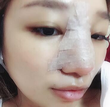 硅胶隆鼻恢复日记 硅胶隆鼻+鼻小柱延长+垫鼻尖