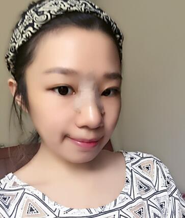 硅胶隆鼻恢复日记 硅胶隆鼻+鼻小柱延长+垫鼻尖
