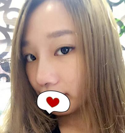 硅胶隆鼻恢复日记 硅胶隆鼻+鼻小柱延长+垫鼻尖