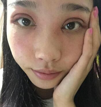 全割双眼皮恢复日记 全切双眼皮+开眼角