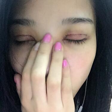 全割双眼皮恢复日记 全切双眼皮+开眼角