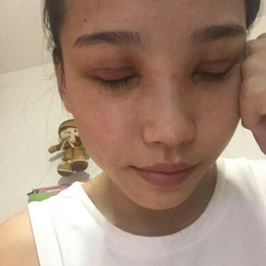 全割双眼皮恢复日记 全切双眼皮+开眼角