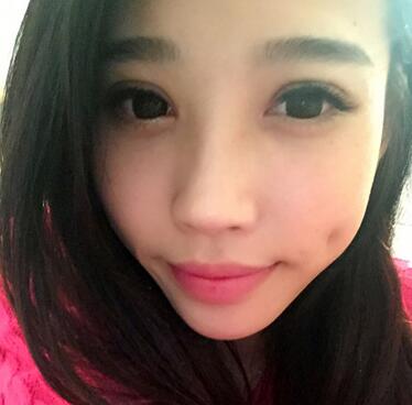 全割双眼皮恢复日记 全切双眼皮+开眼角