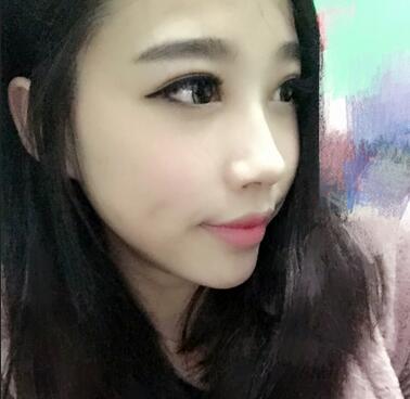 全割双眼皮恢复日记 全切双眼皮+开眼角