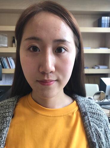 面部脂肪填充后图片 自体脂肪面部填充恢复记录