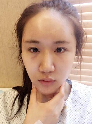 面部脂肪填充后图片 自体脂肪面部填充恢复记录