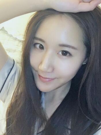 面部脂肪填充后图片 自体脂肪面部填充恢复记录