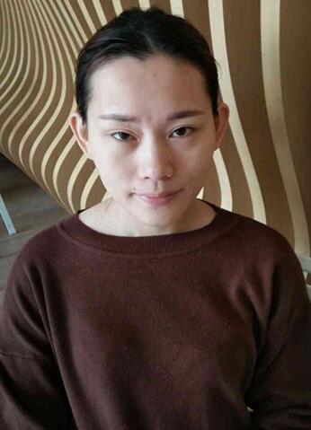 详细部脂肪填充果图 术后恢复分享