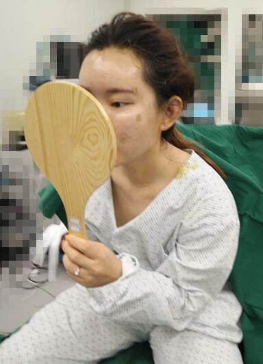 详细部脂肪填充果图 术后恢复分享