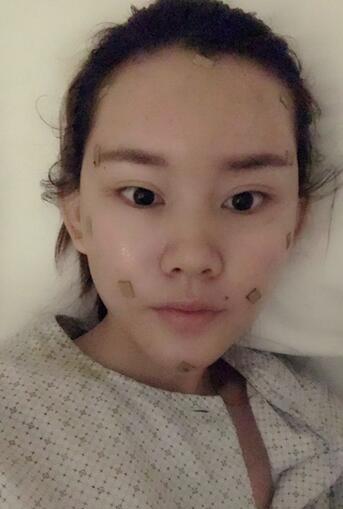 详细部脂肪填充果图 术后恢复分享