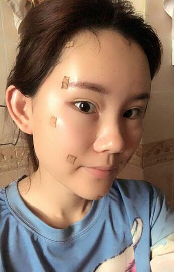 详细部脂肪填充果图 术后恢复分享