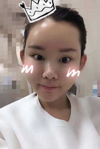 详细部脂肪填充果图 术后恢复分享