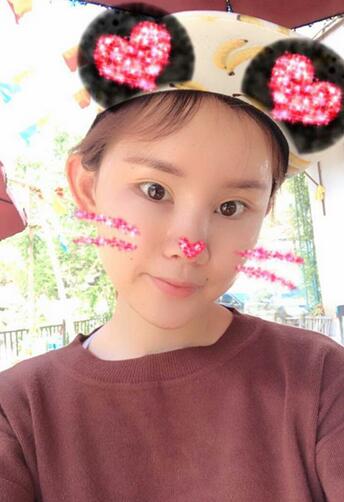 详细部脂肪填充果图 术后恢复分享