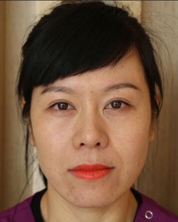 面部埋埋蛋白线.提升恢复过程分享