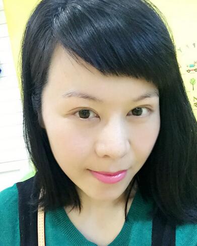 面部埋埋蛋白线.提升恢复过程分享