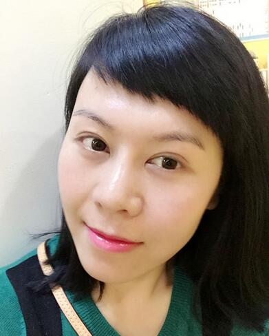 面部埋埋蛋白线.提升恢复过程分享