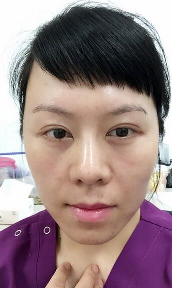 面部埋埋蛋白线.提升恢复过程分享