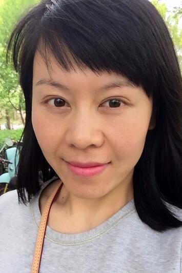 面部埋埋蛋白线.提升恢复过程分享